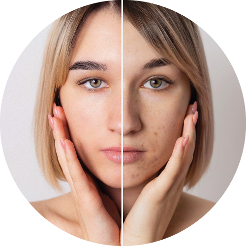 AHA_BHA_Anti_acne_savas_kezeles_kemiai_hamlasztas_budapest_7_kerulet_kozmetika_chemical_peel_budapest_salon_borapolasi_rutin_tudatos_borapolas