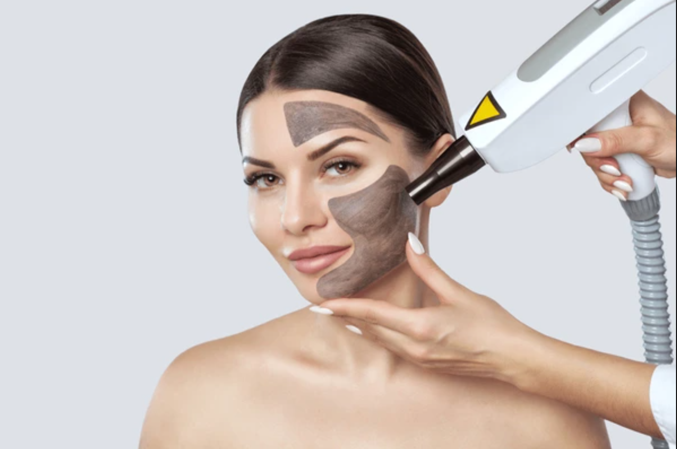 Carbon_Peeling_kezeles_laser_treatment_Budapest_7_kerulet